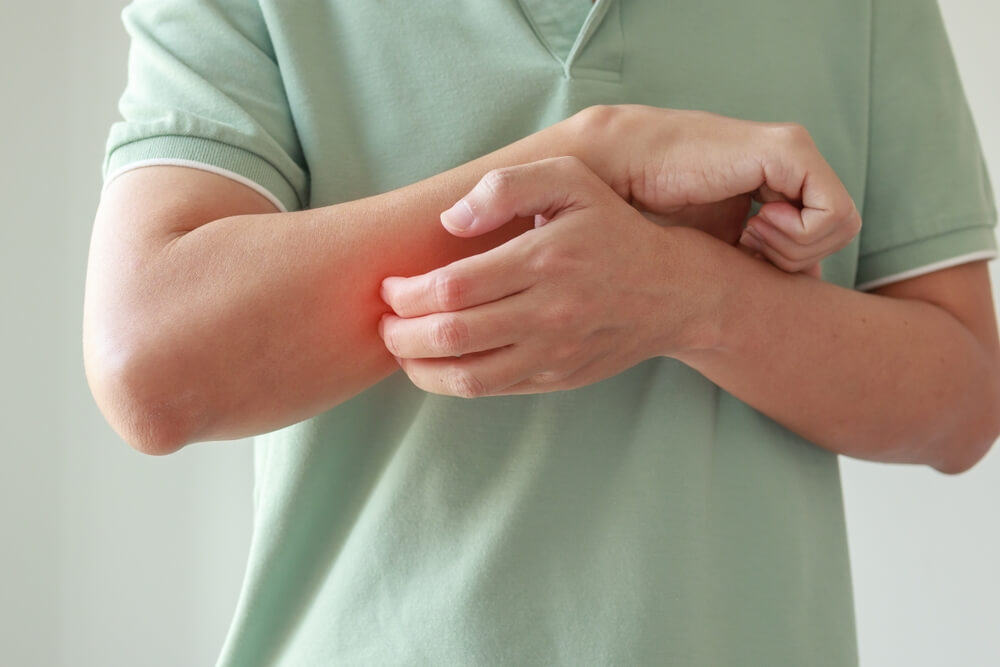 A man scratches his arms. Learn more about if hydrocodone really causes itching, here.