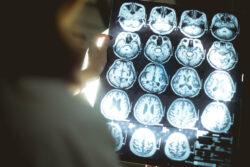 A doctor looking at a collection of brain scans. Learn more about narcotics effects on the body